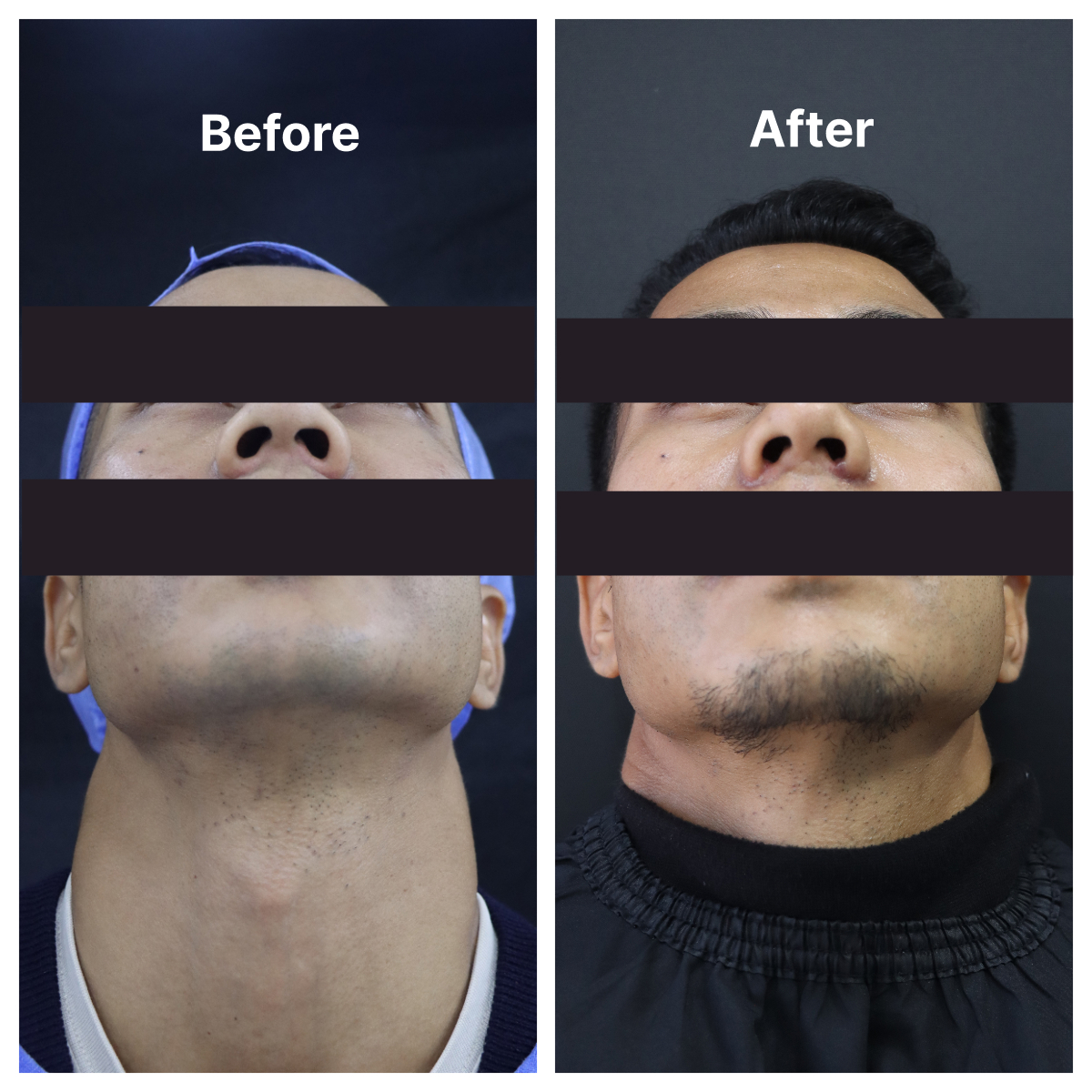 Rhinoplasty result KOQ10